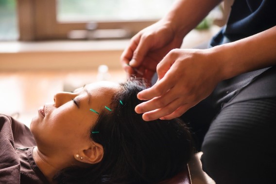 Woman receiving an acupuncture massage